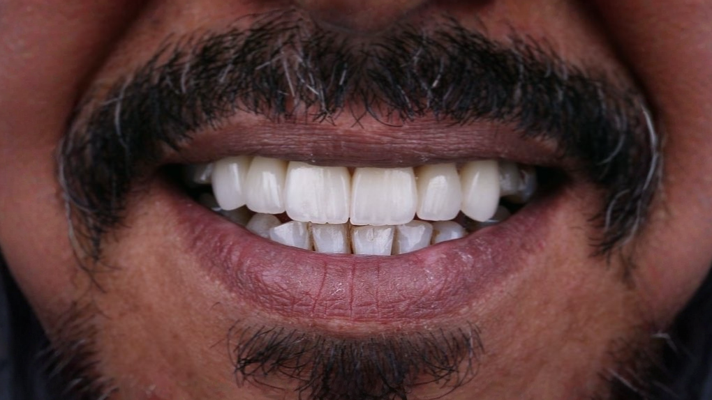 إنفيزالاين after — Al-Fairoz Dental