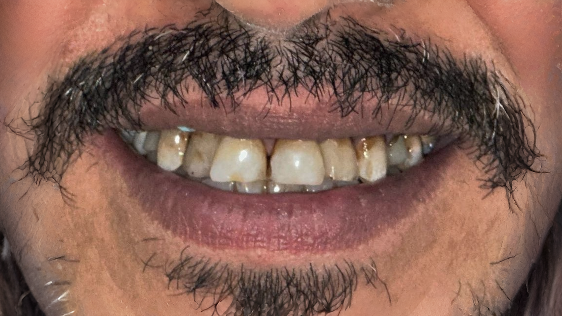 إنفيزالاين before — Al-Fairoz Dental
