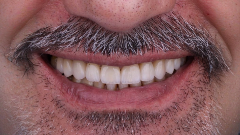الحافظات الشفافة after — Al-Fairoz Dental