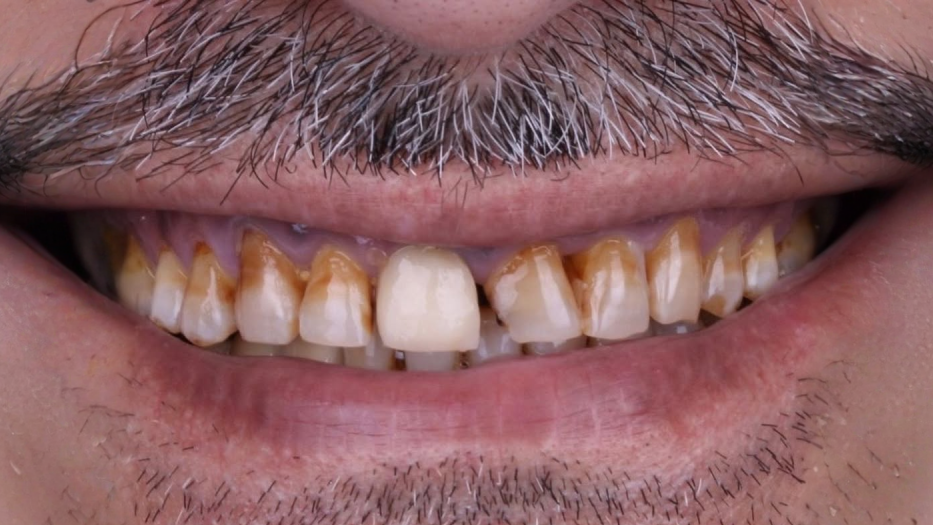 الحافظات الشفافة before — Al-Fairoz Dental