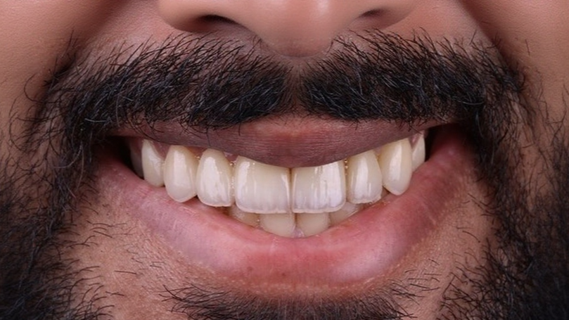 ابتسامة الفنيير after — Al-Fairoz Dental