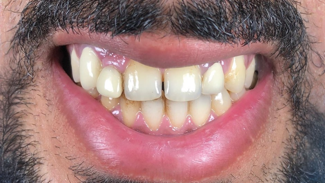 ابتسامة الفنيير before — Al-Fairoz Dental