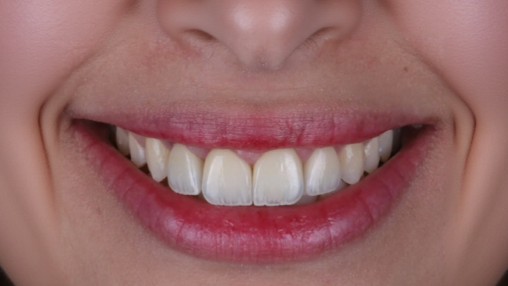 تبييض الأسنان after — Al-Fairoz Dental