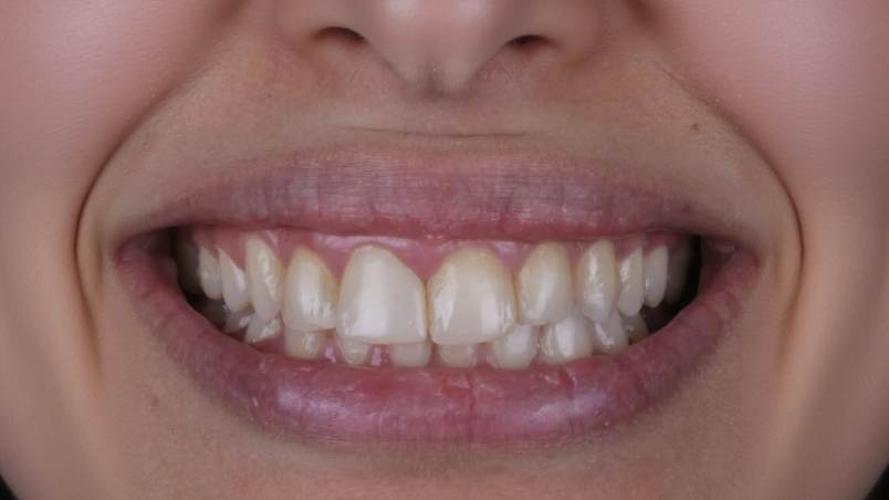 تبييض الأسنان before — Al-Fairoz Dental